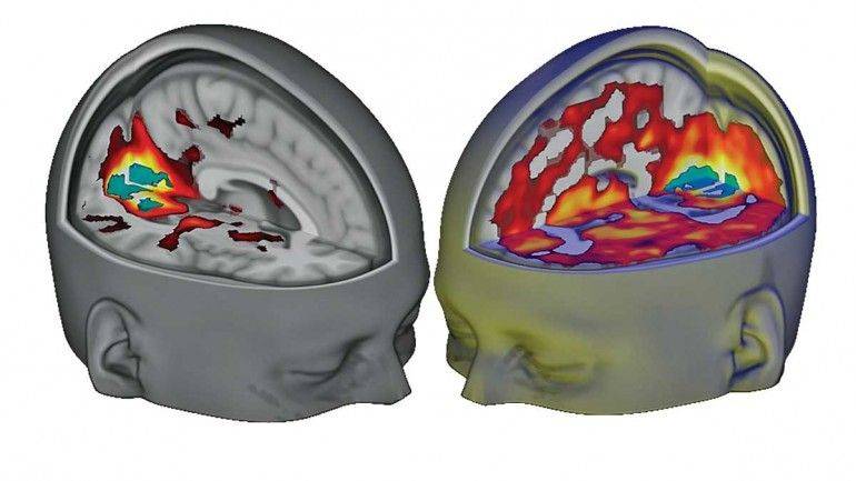 Como funciona um cérebro sob efeito de LSD