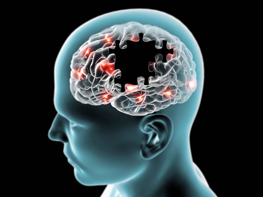 Como é a cura da Alzheimer?
