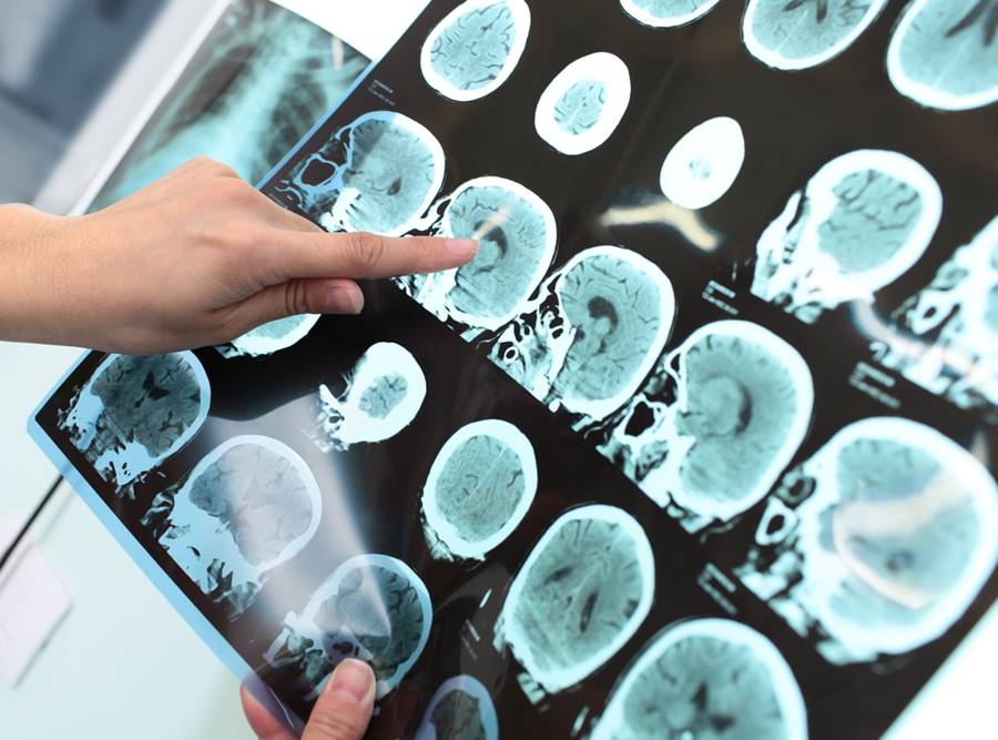 Tratamento e cura da Alzheimer